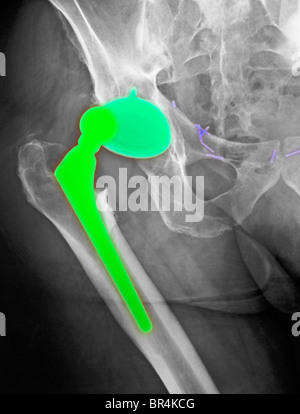 hip x-ray of a 69 year old male with a dislocated hip prosthesis Stock Photo