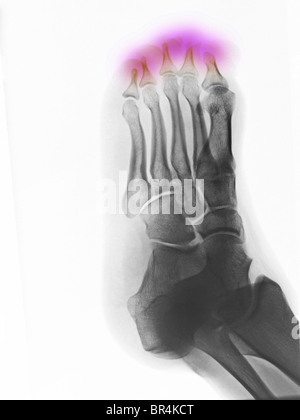 Foot x-ray of a 25 year old man showing congenital absence of the ...