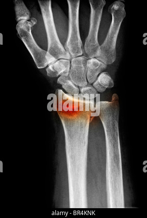 wrist x-ray of a 63 year old woman who fell and fractured her distal radius and ulna Stock Photo