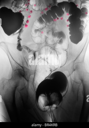 Abdomen x-ray of a barium contrast examination showing diverticulosis of the colon of a 67 year old woman Stock Photo