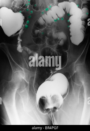 Abdomen x-ray of a barium contrast examination showing diverticulosis of the colon of a 67 year old woman Stock Photo