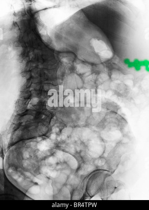 abdomen x-ray of a 59 year old woman with gallstone Stock Photo