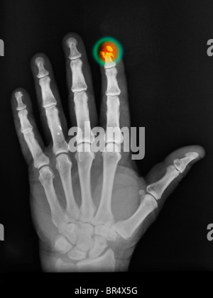 x-ray of the hand of a 64 year old man who crushed his fingertip Stock Photo