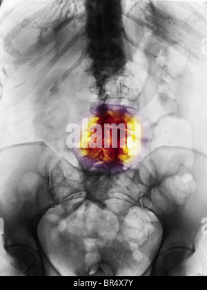 Lumbar spine x-ray of a 79 year old woman with degenerative arthritis ...