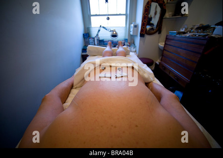 Acupuncture for smoking cessation in Wainscott, NY Stock Photo