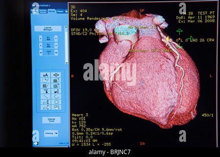Computer monitor displaying CAT scan image of heart Stock Photo