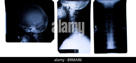 X-Ray film of neck and head - three views - front and side Stock Photo