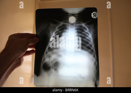 x-rays of wounded civilians in Afghanistan Stock Photo