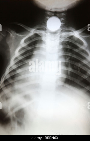 x-rays of wounded civilians in Afghanistan Stock Photo