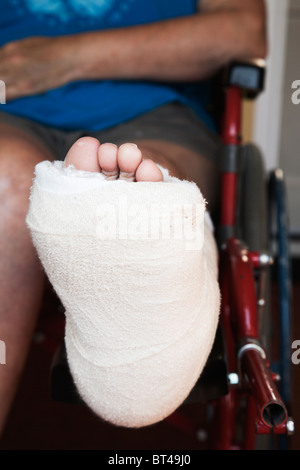 Foot view of a woman with broken ankle bones set in a 'Back Slab' plaster-cast. Stock Photo