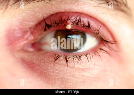 Eye stye (sty or hordeolum) Stock Photo