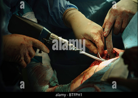 Doctors performing orthopedic surgery in operating room Stock Photo