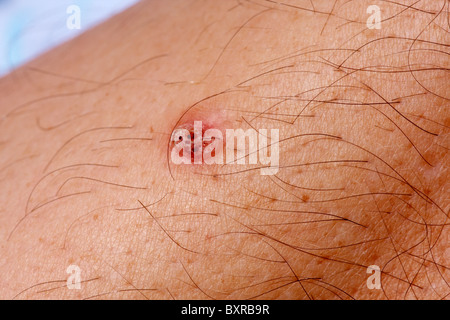 Viral Wart Stock Photo: 6043785 - Alamy