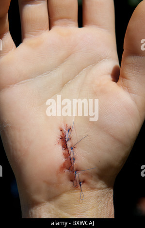 Wound from an operation for carpal tunnel syndrome. Stock Photo