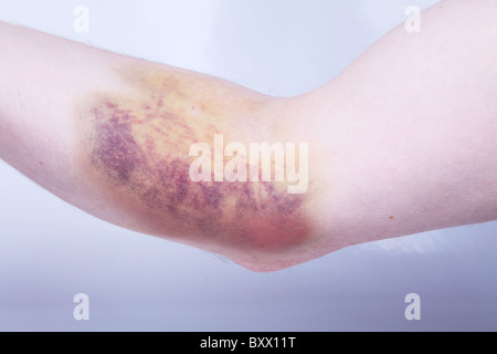 Bruising (hematoma, or haematoma) caused by internal bleeding as a result of blood sample having been taken. Stock Photo