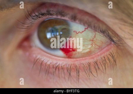 Man's eye with a Subconjunctival Hemorrhage, close up Stock Photo
