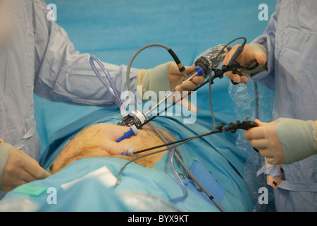 Laparascopic surgery to repair an inguinal hernia Stock Photo