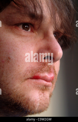 Profile shot of a man with cold sores on his lips Stock Photo