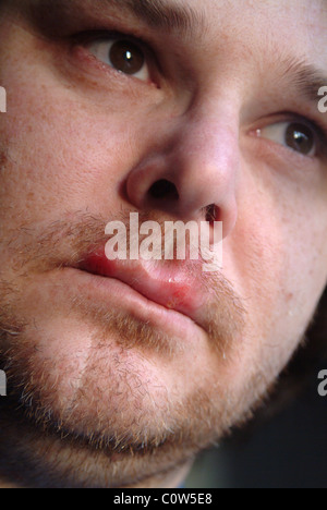 Head shot of a man with cold sores on his lips Stock Photo