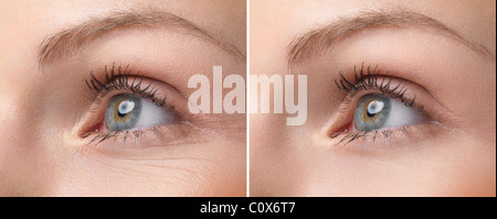License and prints at MaximImages.com - Closeup of woman's eye with and without wrinkles. Before and after photos of threatment by the product of your Stock Photo