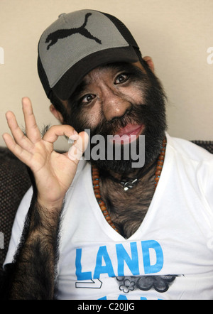 IT'S HAIR TODAY, GONE TOMORROW... The world's hairiest man bristles as he prepares for surgery - to smooth out his skin. Yu Stock Photo