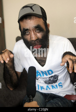 IT'S HAIR TODAY, GONE TOMORROW... The world's hairiest man bristles as he prepares for surgery - to smooth out his skin. Yu Stock Photo