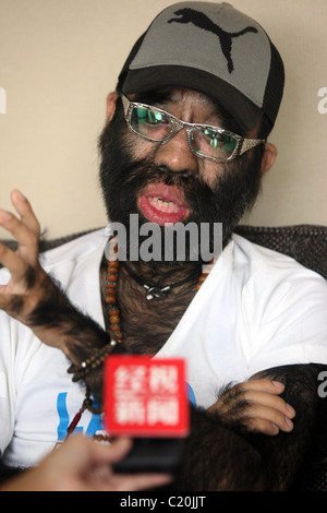 IT'S HAIR TODAY, GONE TOMORROW... The world's hairiest man bristles as he prepares for surgery - to smooth out his skin. Yu Stock Photo