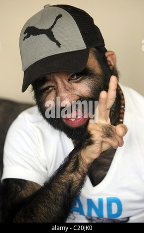 IT'S HAIR TODAY, GONE TOMORROW... The world's hairiest man bristles as he prepares for surgery - to smooth out his skin. Yu Stock Photo