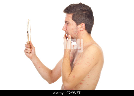 Man with chickenpox looking with surprised face in a mirror isolated on white background Stock Photo