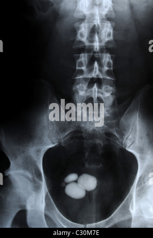 authentic x-ray picture of kidney stones in urinary bladder - ureterolithiasis Stock Photo