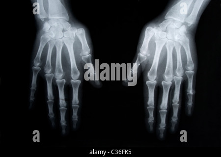 black and white photo of x-ray picture of human hands Stock Photo