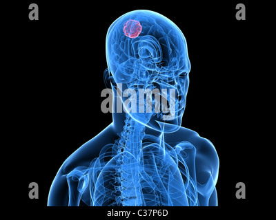 liver cancer Stock Photo