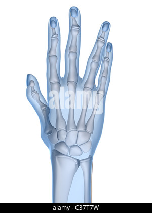 x-ray hands - arthritis Stock Photo