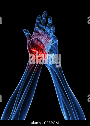 x-ray hands - arthritis Stock Photo