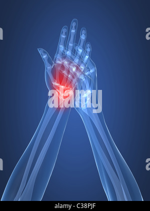 x-ray hands - arthritis Stock Photo