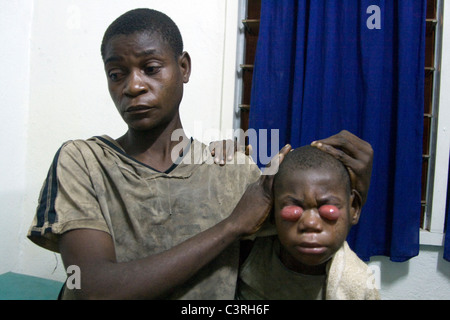 pediatric care,Betou hospital MSF,Republic of Congo; Conjonctivite grave suite à des soins indigènes chez des pygmés Stock Photo