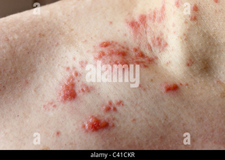 up macro poison rash blisters on human skin stock photo royalty free image 124345749 poison rash and blisters on a leg stock photo 144560388 alamy up macro poison rash blisters on human skin stock photo royalty free image 124345749 poison rash and blisters on a leg stock photo 144560388 alamy