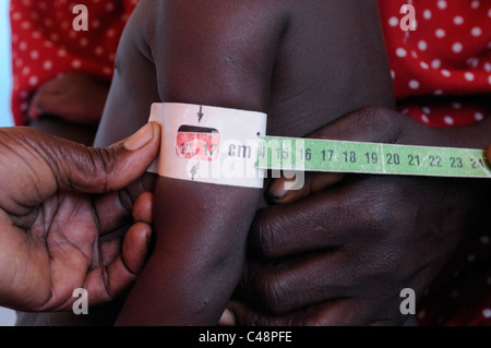 An African toddler is being screened for malnutrition at a medical center in Malawi Africa Stock Photo