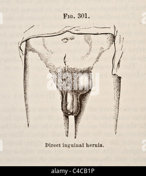 Antique Medical Illustration Depicting Hernia circa 1881 Stock Photo
