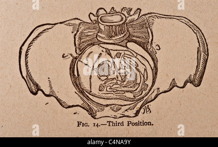 Antique medical illustration of a pelvic bone Stock Photo