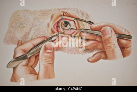 Antique medical illustration of eye disease and Ophthalmologic surgery ...