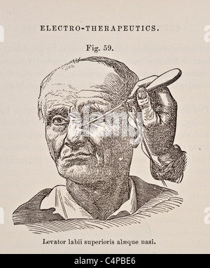 Illustration of Levator Labii Superioris Alaeque Nasi circa 1881 Stock Photo