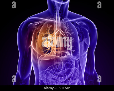 lung cancer Stock Photo