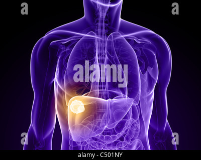 liver cancer Stock Photo