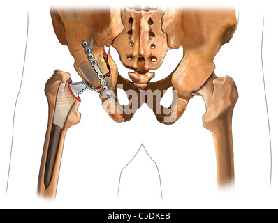 acetabular fracture