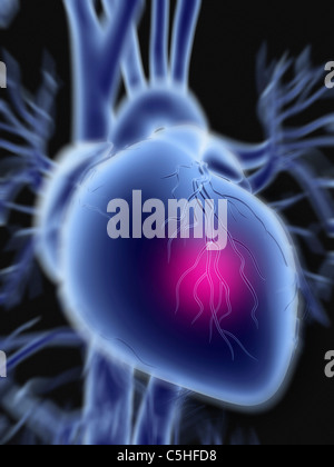 Heart attack Stock Photo