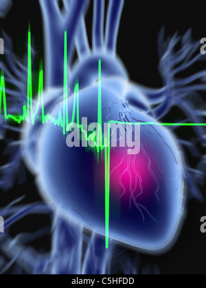 Heart attack and ECG trace Stock Photo