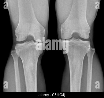 KNEE, X-RAY EXAMINATION Stock Photo: 48411937 - Alamy