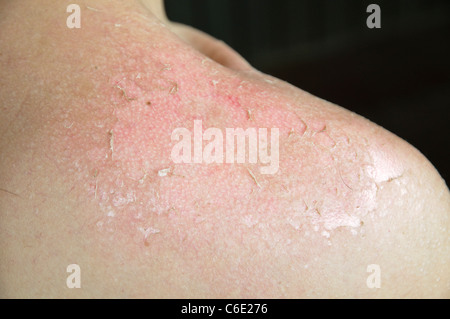 Severe sunburn with detaching skin Stock Photo