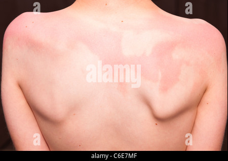 An eleven year old boy shows his sunburnt back with the patches where the suncream was n't spread evenly enough Stock Photo